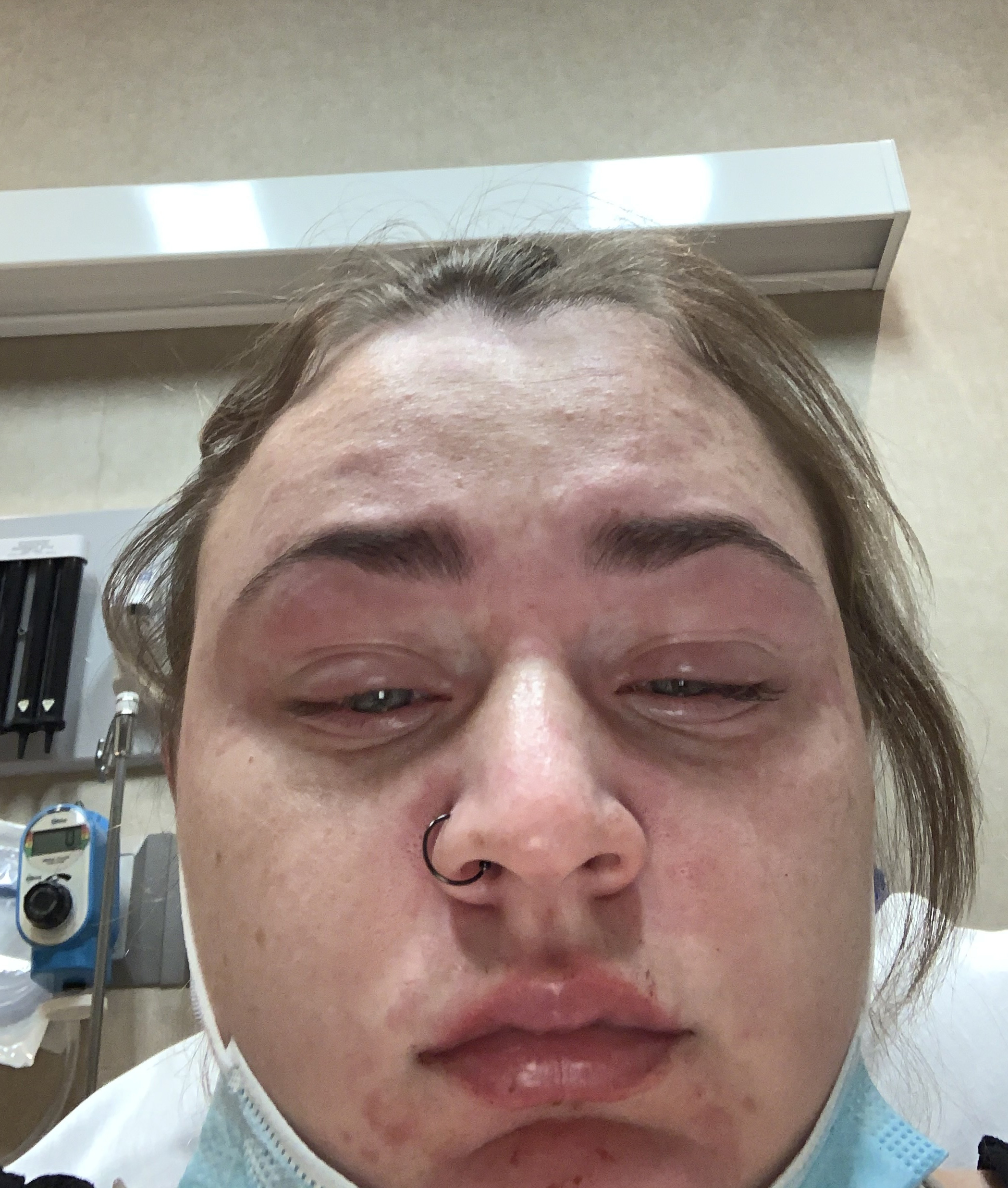 allergic reaction face