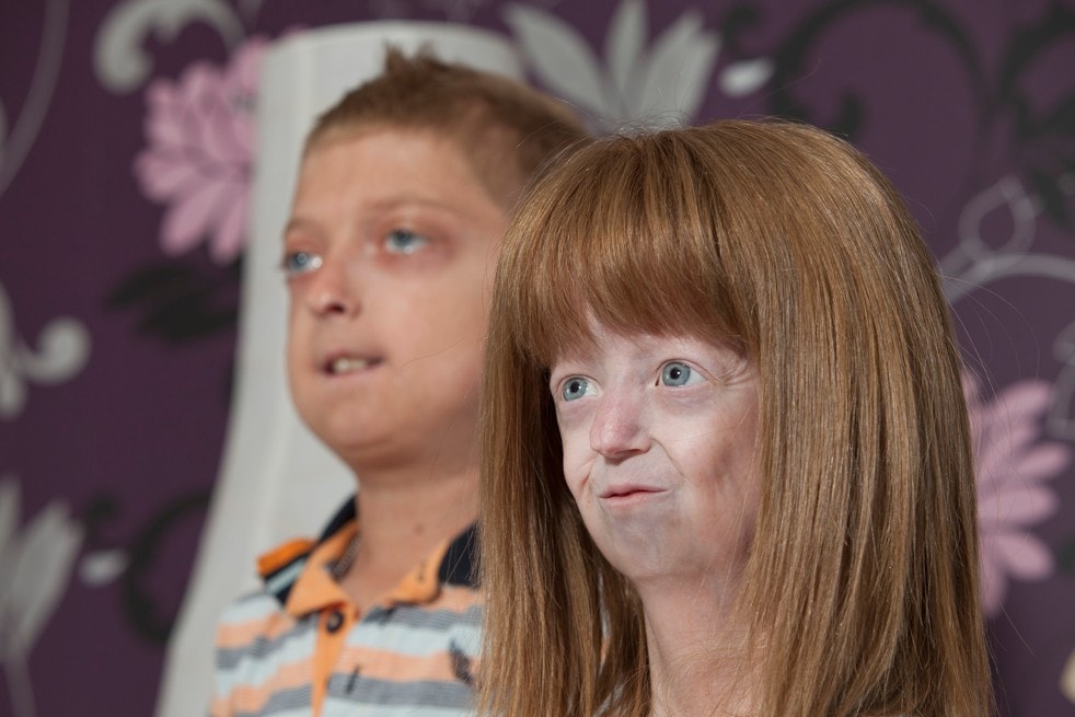 Hayley Okines A Teen Trapped In A 104 Year Old S Body Dies At 17 The Washington Post