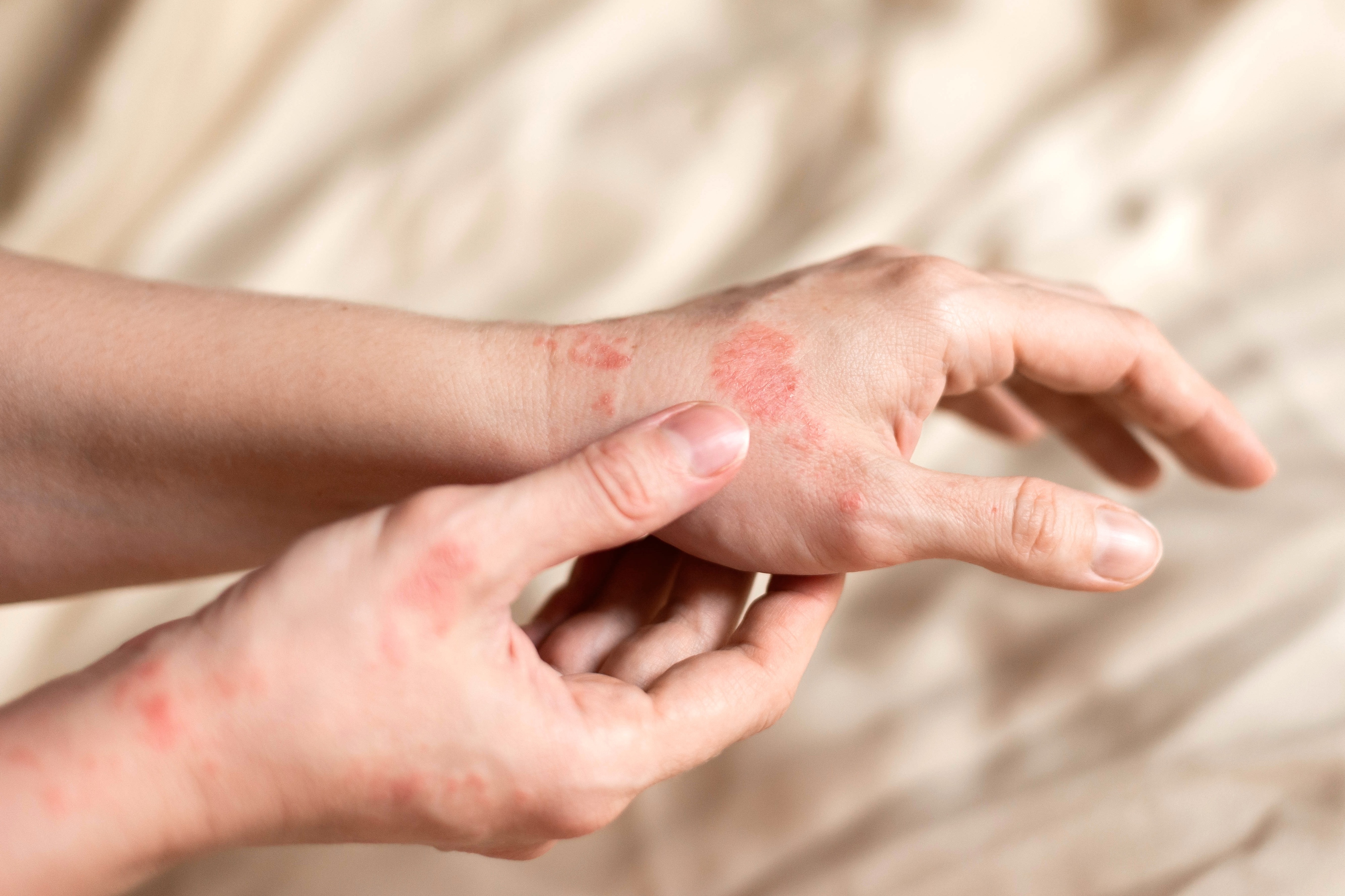 A salty diet may increase eczema in adults, study finds - Vimarsana News